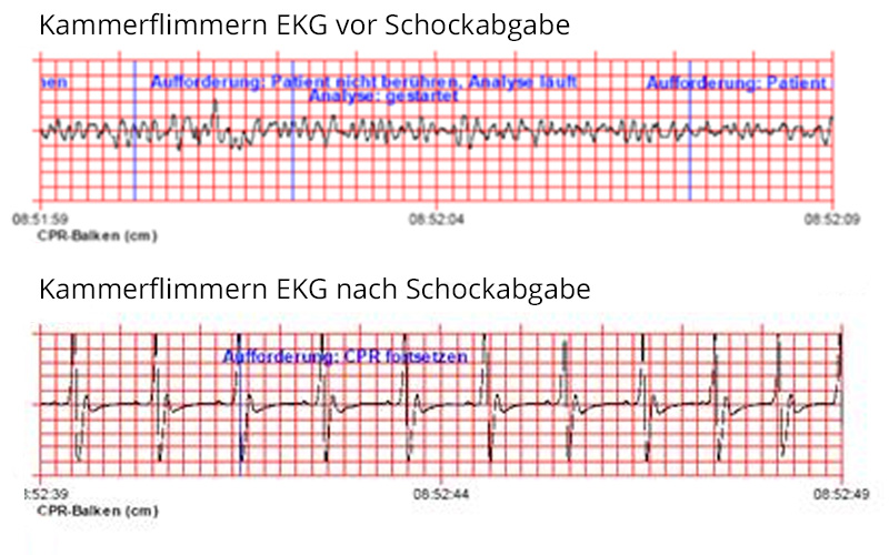 Projekt-oeffentliche-Defibrillatoren-AED-Herzpraxis-Aegeri-Herzspezialist